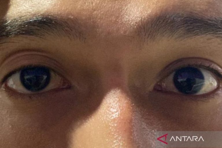 Mengenal Ptosis, kondisi mata telihat "ngantuk" menurut medis 